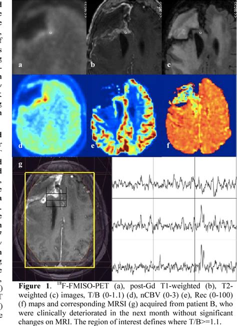 Figure 1 From Imaging Of Hypoxia In Recurrent GBM Using 18 F