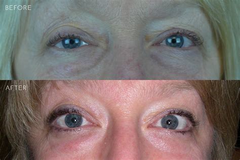 Ptosis Repair Before And After Photos Kirkland Bellevue Marina Park