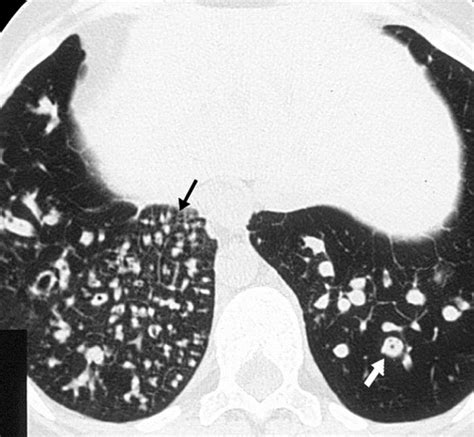 Tree In Bud Pattern At Thin Section CT Of The Lungs Radiologic