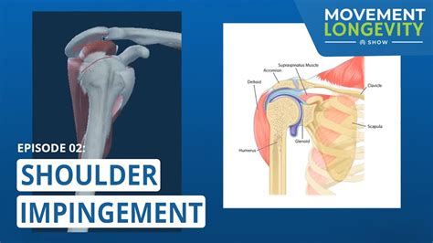 Shoulder Impingement Syndrome Causes Treatment And Rehabexercise