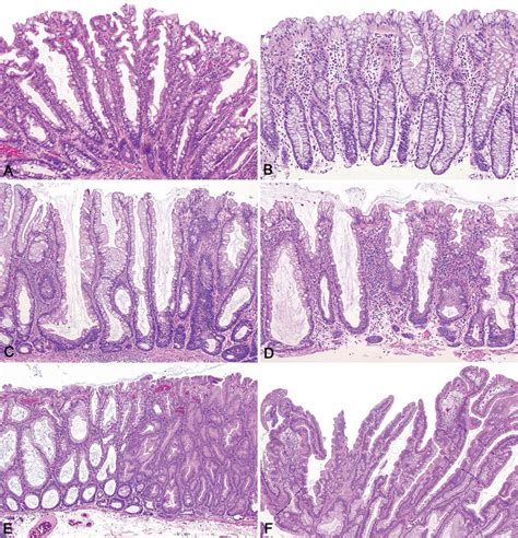 Sessile Serrated Adenoma Vs Hyperplastic Polyp