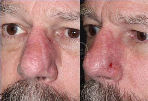 Recurrent SCC Of Nasal Tip Skin Cancer And Reconstructive Surgery Center