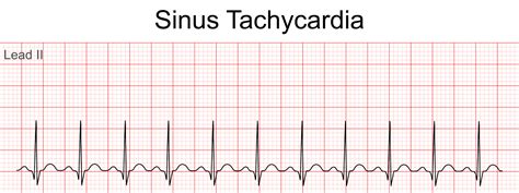 Sinus Tachycardia