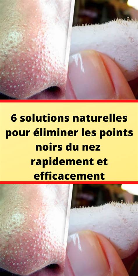 6 solutions naturelles pour éliminer les points noirs du nez rapidement