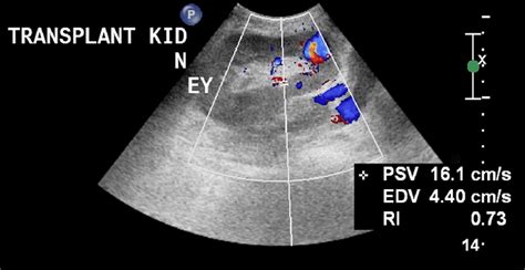 Doppler Ultrasound Showing The Typical Ying Yang Sign That Is Highly