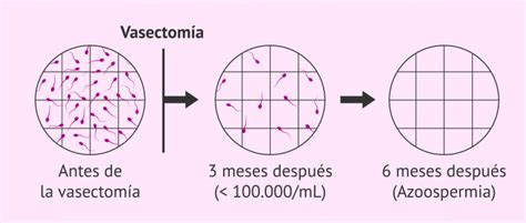 Resultado Del Seminograma Tras Una Vasectomía