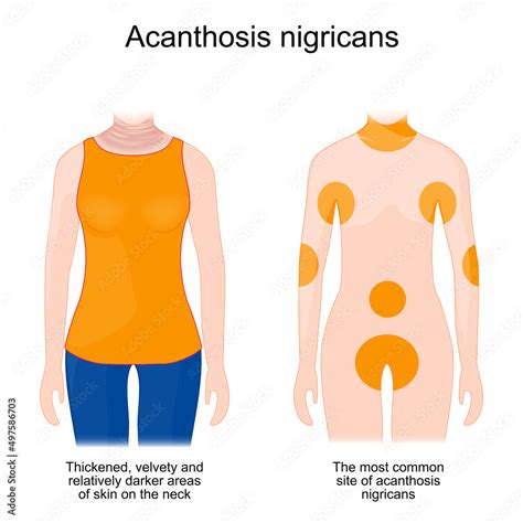 Acanthosis nigricans. Sign and symptoms Stock Vector | Adobe Stock