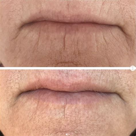 Fibroblast Plasma Skin Tightening Shape Up Brow Studio