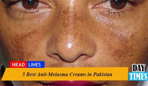 5 Best Anti Melasma Creams In Pakistan By Sumera Saeed Medium