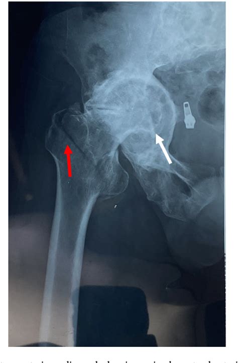 Pertrochanteric Fracture Of An Ankylosed Hip With Protrusio Acetabuli