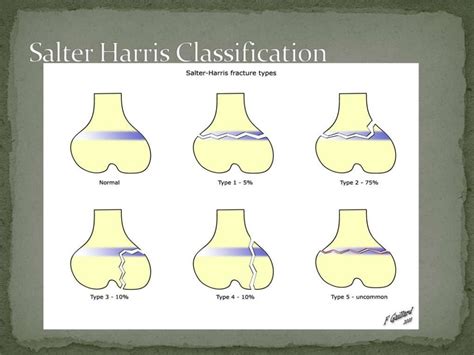 Salter Harris Type 3 Fracture