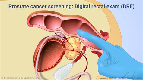 Slide Show Understanding Prostate Cancer