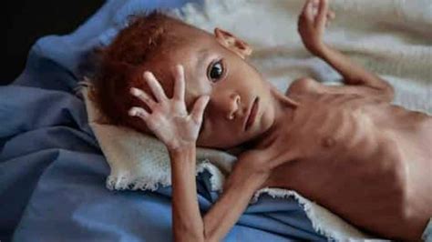 Over 33 lakh Indian children malnourished, 17.7 lakh severely affected ...