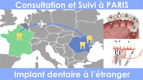 Implant dentaire à l etranger avec consultation et suivi a Paris YouTube