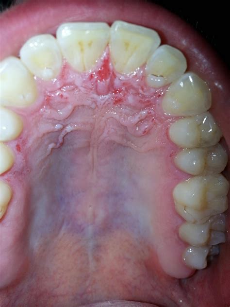 reasons   roof   mouth hurts
