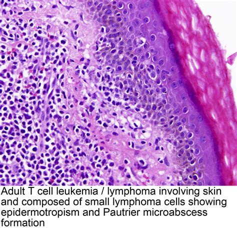 Pathology Outlines Atll