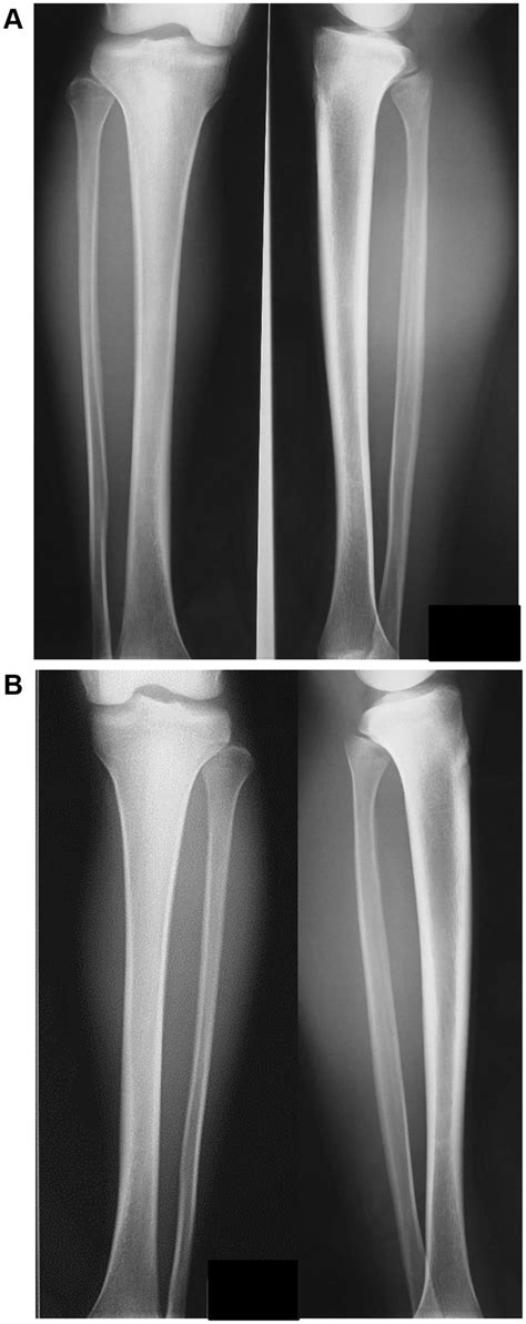 Initial Radiographs Show Suspected Tibial Stress Fracture Or Shin