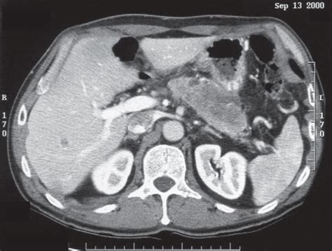 This nonfunctional islet cell cancer was treated by resection of the ...