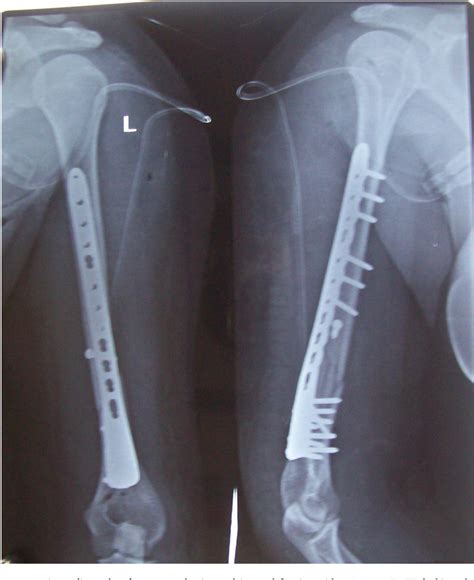 Figure 3 From Modified Application Of Distal Medial Tibial Locking