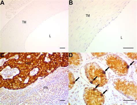 Chromogranin A Detection By Immunohistochemistry A Lack Of