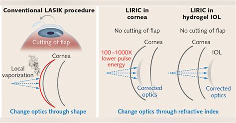 Ophthalmology Femtosecond Lasers Liric Next Generation Refractive Laser Surgery Laser Focus