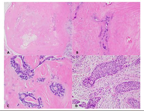 Figure From Sebaceous Epithelial Myoepithelial Carcinoma With