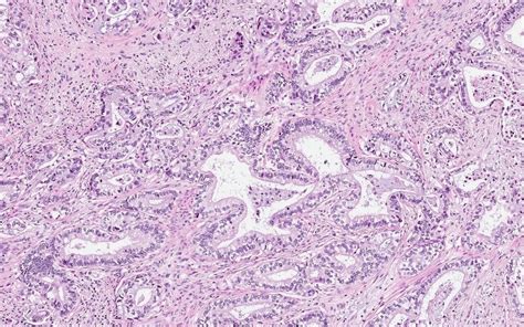 Pathology Outlines Gastric Type Adenocarcinoma