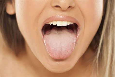 Geographic Tongue Causes Symptoms And Treatment