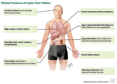 Liver Health Facts Community Liver Alliance