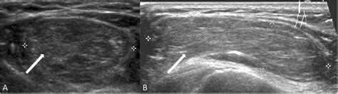 Right Shoulder Lipoma A Transverse And B Sagittal Gray Scale Images Download Scientific