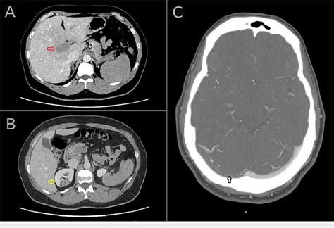 A And B CT Of The Abdomen With Contrast And C CT Of The Head With