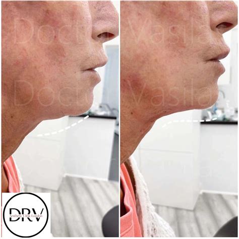 Double Chin Treatment London Chin Fat Dissolving Injections