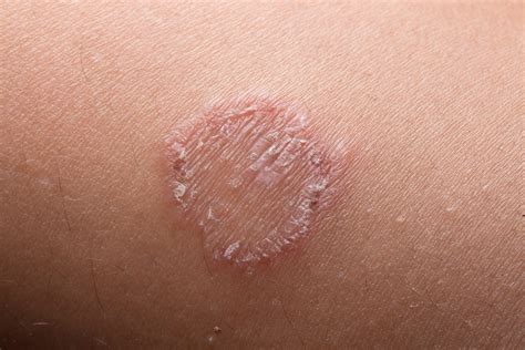 Ringworm Tinea Corporis Katu Dermatology Clinic