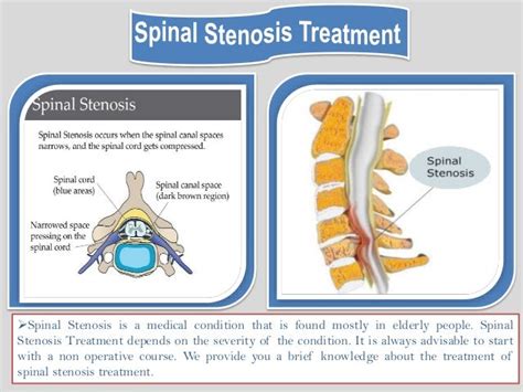 Cervical spinal stenosis surgery