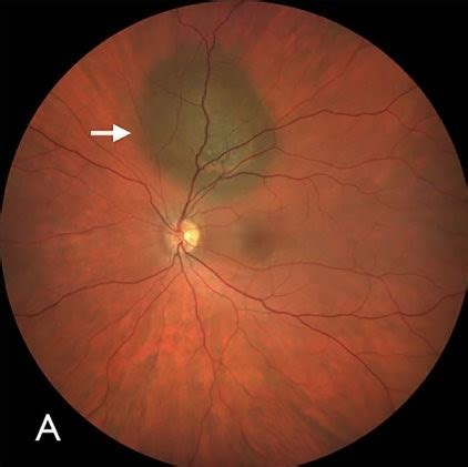 Choroidal Melanoma What Is It Causes And Treatment