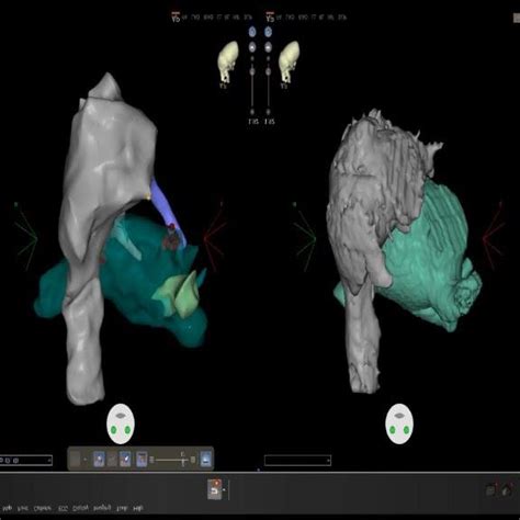 Left Panel Showing The Three Dimensional Electroanatomical CARTO Maps