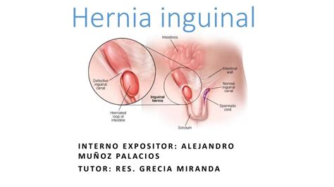 Resúmenes de Hernias inguinales Descarga apuntes de Hernias inguinales