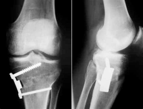 Medial Open Wedge Osteotomy Fixed With Puddu Plate Download