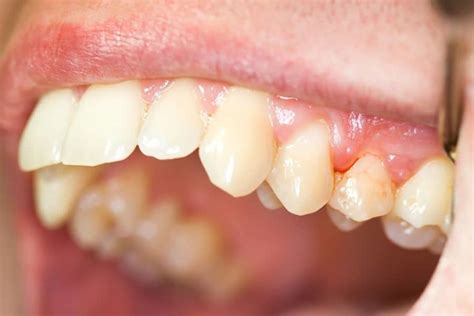 What Does Gingivitis Look Like Signs Of Gingivitis Evdp