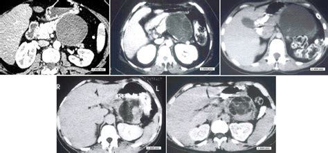 Pancreas Cysts Pancreatic Cancer Johns Hopkins Pathology