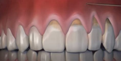 Pinhole® Gum Rejuvenation Holmdel Nj Holmdel Periodontics