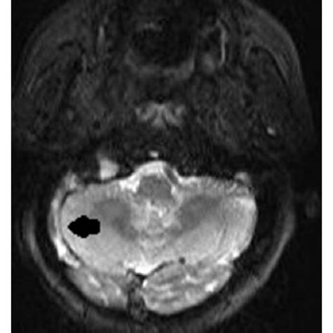 Air Bubbles As Seen In The Brain Ct Of The Right Sigmoid Sinus