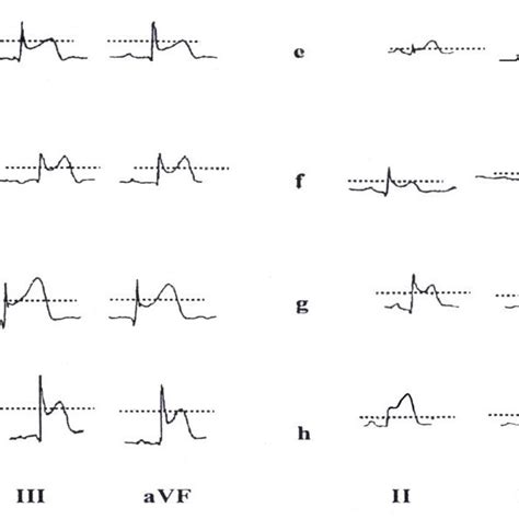 Qrs Distortion In Inferior Leads Negative Qrs Distortion Defined As Download Scientific