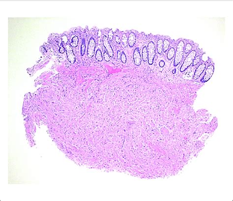 Granular Cell Tumor Plump Polygonal Cells With Abundant Eosinophilic