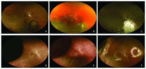 Endoresection A Mushroom Shaped Choroidal Melanoma In The Only Eye