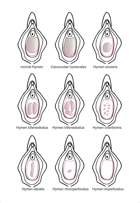 qué Puede Causar La Rotura Del Himen Flujo Vaginal Free Download