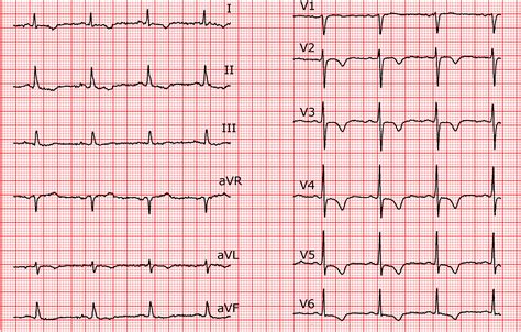 V1 V2 V3 V4 V5 V6 Ecg SOLOLEARN