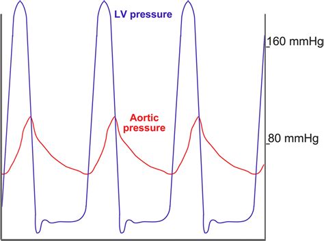 Example Of Simultaneous Pressure Measurements In The Left Ventricle And