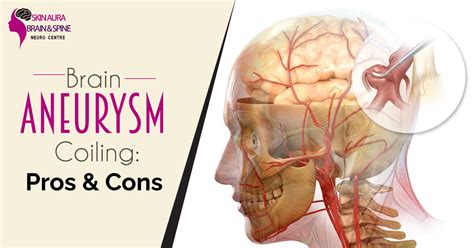 Brain Aneurysm Coiling Pros And Cons