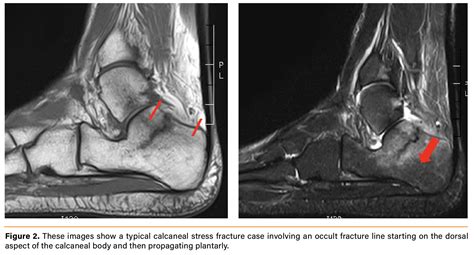 Treating Calcaneal Stress Fractures in Athletes | Podiatry Today